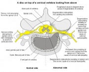 Basic Picture of a Cervical Vertebral Body