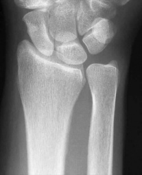 Colles Fracture - Physiopedia