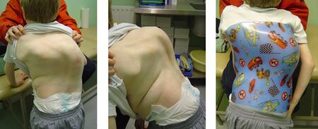 Neuromuscular Scoliosis - Donna's Own Images.jpg