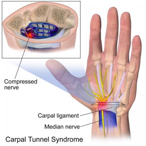 Image showing carpal tunnel syndrome