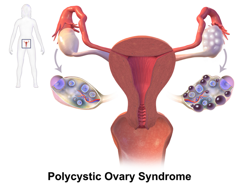 File:PCOS.png