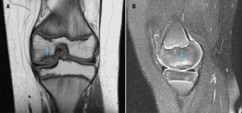 File:MRI for osteochondral defect.jpg
