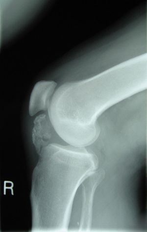 Osteochondroma X-ray.jpg