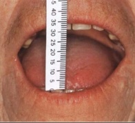 Measurement of oral aperture (9)
