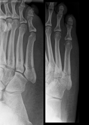 X ray of 5th metatarsal (Jones) fracture