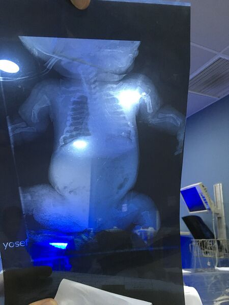 File:1024px-X ray for osteogenesis imperfecta.jpeg