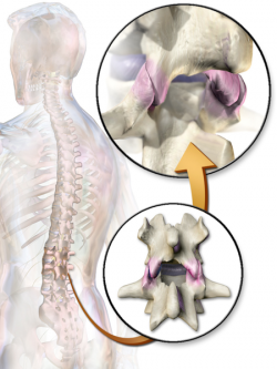 Facet Joint Syndrome - Physiopedia