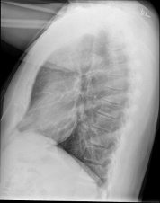 Lateral Chest X-Ray