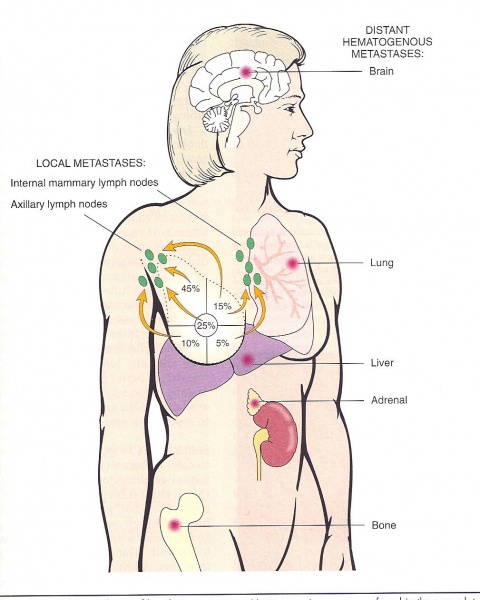File:Breast Cancer Metastases Diagram1 .jpg