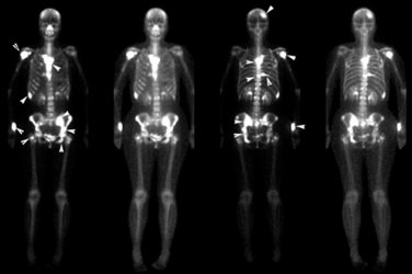 Bone scan.jpg