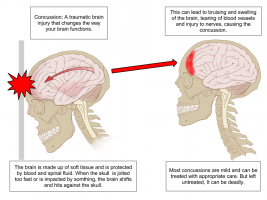 Concussion Anatomy.png