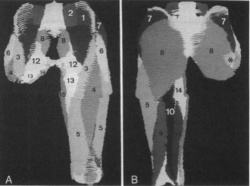 Fig 5A-B. Three-dimensional reconstructions of an above-knee amputation with a short stump in a ventral (A) and dorsal view (B). (1, iliacus; 2, psoas major; 3, sartorius; 4, rectus femoris; 5, vastus musculature; 6, tensor fasciae latae; 7, gluteus medius; 8, gluteus maximus; 9, biceps femoris; 10, semitendinosus; 11, semimembranosus; 12, pectineus; 13, adductor longus; 14, adductor magnus; 15, gracilis; *femur.)