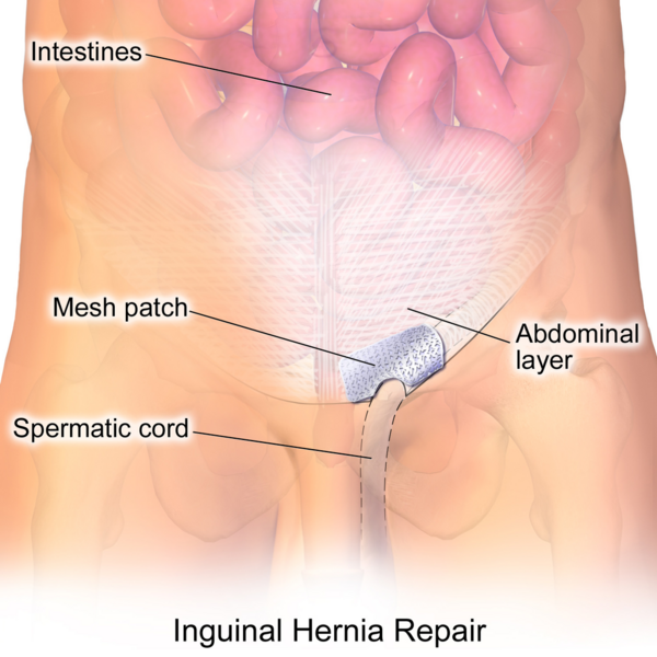File:Inguinal Hernia Repair.png