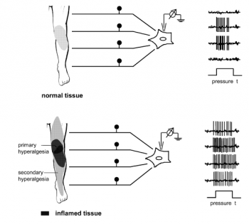 Figure 3: normal neural activity vs spinal neurones in a state of hyper-excitability (Sciable and Richter, 2004)
