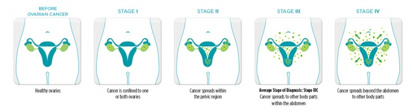 Ovarian Cancer Recurrence Weight Loss