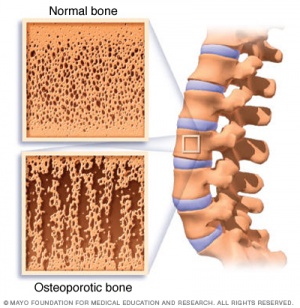 Mcdc7 osteoporosis compare.jpg