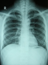 PA Chest X-Ray