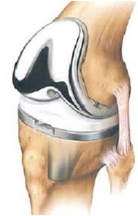 Total knee arthroplasty.jpg