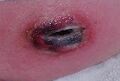 Periwound and spreading erythema with oedema. Image used with kind permission of Diane Merwarth PT.