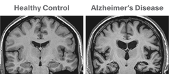 Figure 1. MRI of Alzheimer's Compared to Control.png