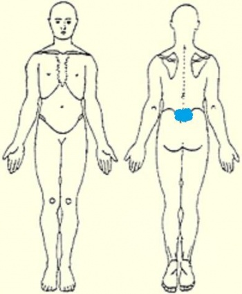 Typical body chart of patient presenting with spondylolysis