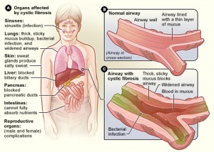 Cysticfibrosis01.jpg