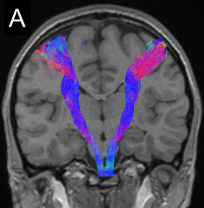 Corticospinal tract tractography reconstruction.png