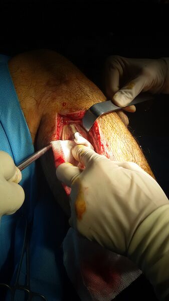 File:1024px-Compartment syndrome with fasciotomy procedure 01.jpeg