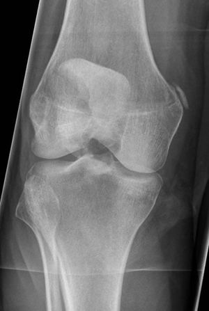 Stieda Pellegrini X-ray.jpg