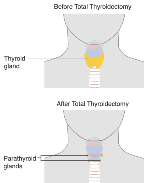 File:Thyroidectomy.png