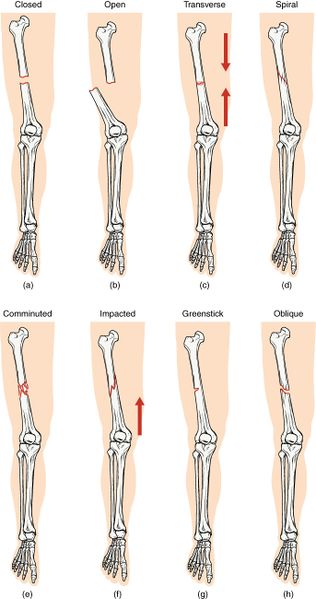 File:Fractures.jpg