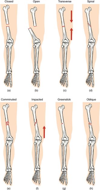 Types of bone fracture.