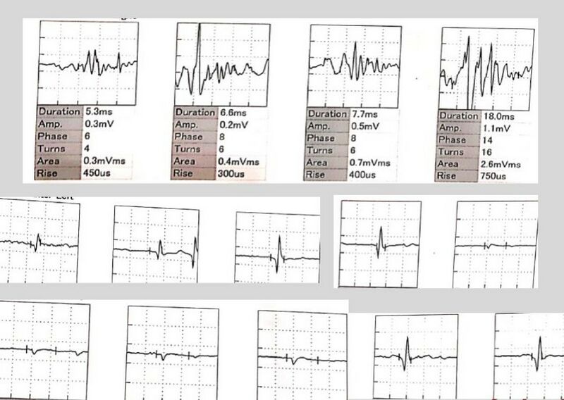 File:EMG picture in a neurological case.jpg