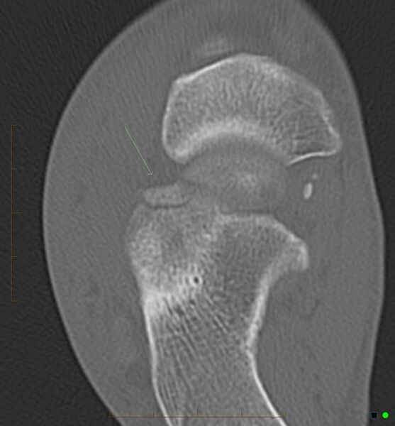 File:Anterior-process-of-calcaneus-fracture.jpg