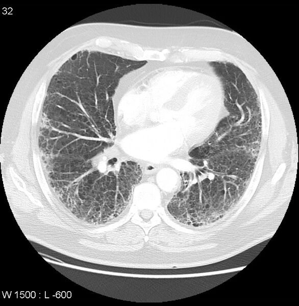 File:Rheumatoid lung.jpeg