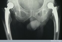 Bilateral total hip replacements x-ray
