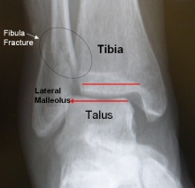 Lateral malleolus fracture AP view
