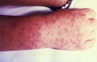 Rash associated with Rocky Mountain Spotted Fever. Image can be found at http://commons.wikimedia.org/wiki/File:Rocky_Mountain_spotted_fever_PHIL_1962_lores.jpg