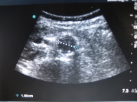 Ultrasound imaging showing a normal sized abdominal aorta