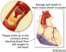 Damaged heart due to an MI