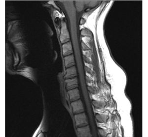 Cervical spine MRI showing degenerative disc disease, osteophytes, and osteoarthritis of C5-C6