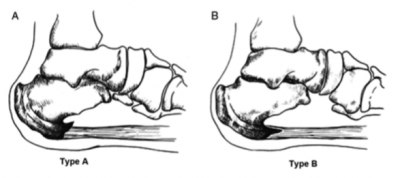 type of calcaneal spur
