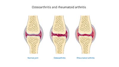Osteoarthritis and rheumatoid arthritis - Normal joint Osteoarthr -- Smart-Servier.jpg