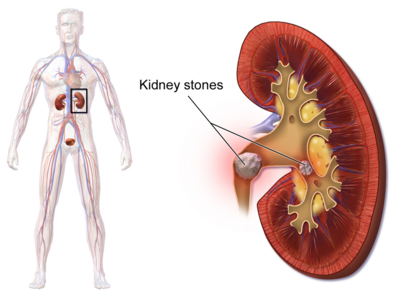 KidneyStones.png