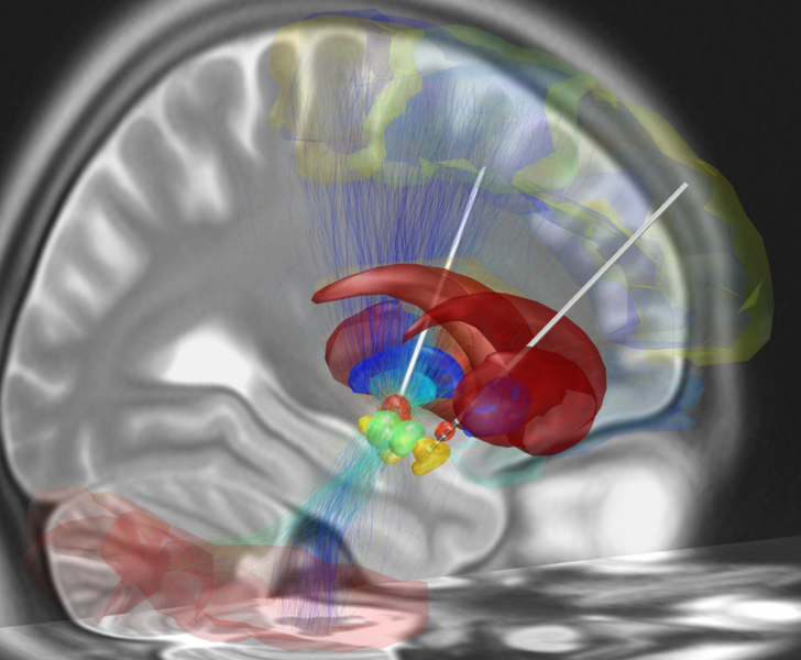 File:Deep brain stimulation electrode placement reconstruction.png