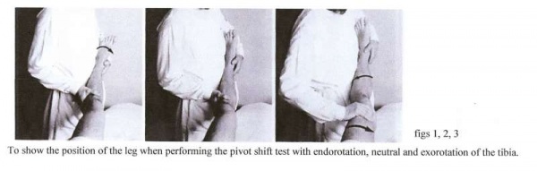 figs 1, 2, 3 To show the position of the leg when performing the pivot shift test with endorotation, neutral and exorotation of the tibia.