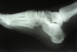 Lateral view radiograph of a calcaneal fracture
