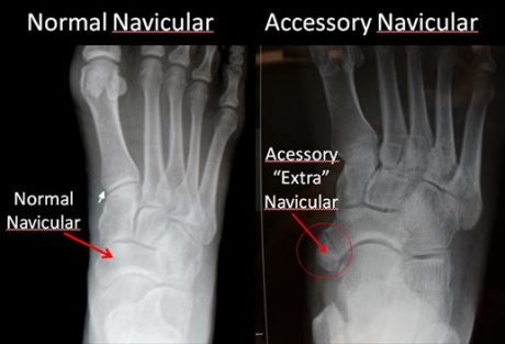 Normal-Navicular-and-Accessory-Navicular.jpg