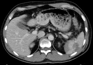 CT Ruptured spleen