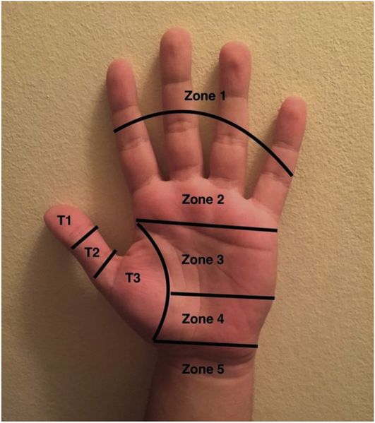File:Flexor tendon injury zones.jpg